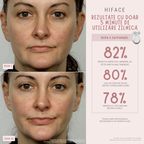 HiFace Aparat cu Microcurent pentru Remodelare, Lifting Facial si Intinerirea Pielii